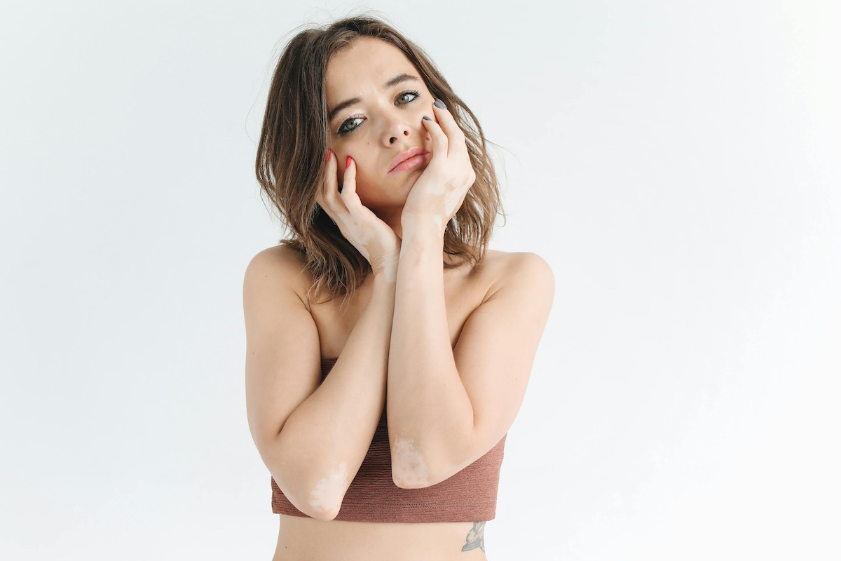 Baltmė – nepavojinga, bet sekinanti psichologiškai liga