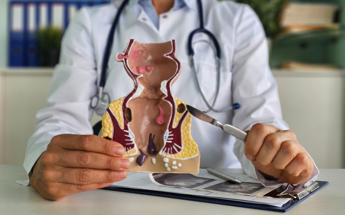 Hemorojus: nėra prasmės gėdytis, reikia gydytis