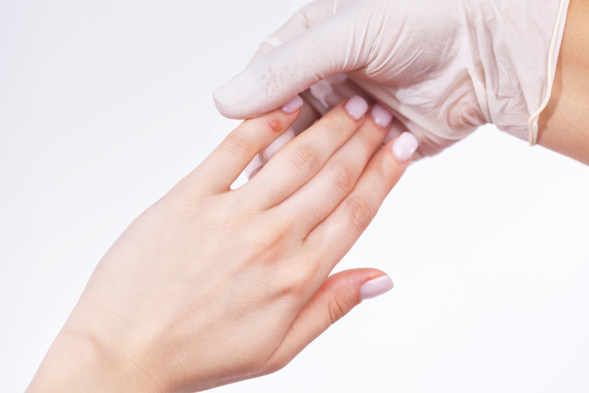 Karpos: nepavojingos, bet norisi kuo greičiau atsikratyti