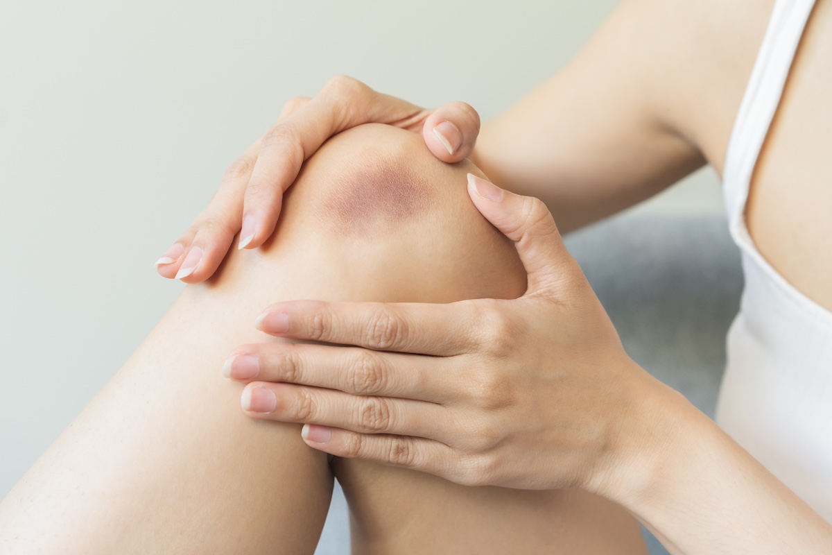 Neignoruokite sumušimų: mėlynės ir patinimas gali slėpti rimtesnius sužalojimus