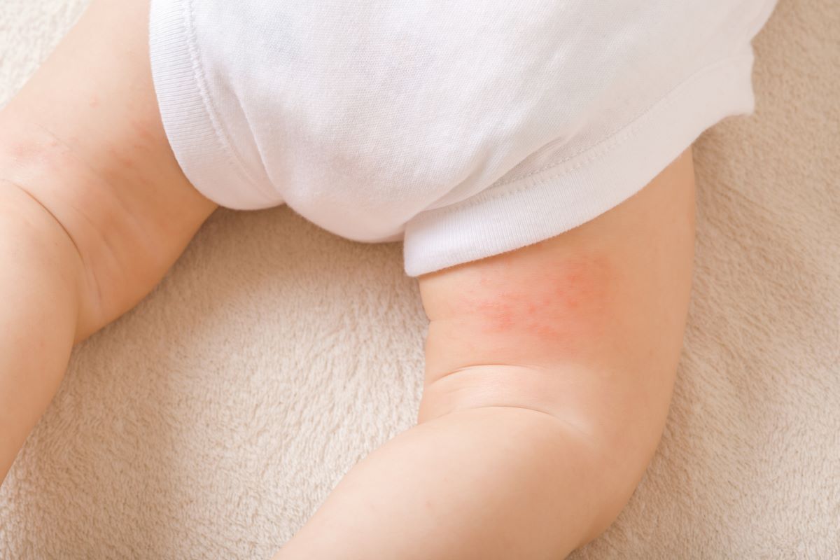 Kūdikių iššutimai: išvengti pasikartojimo ir komplikacijų padės tinkama priežiūra